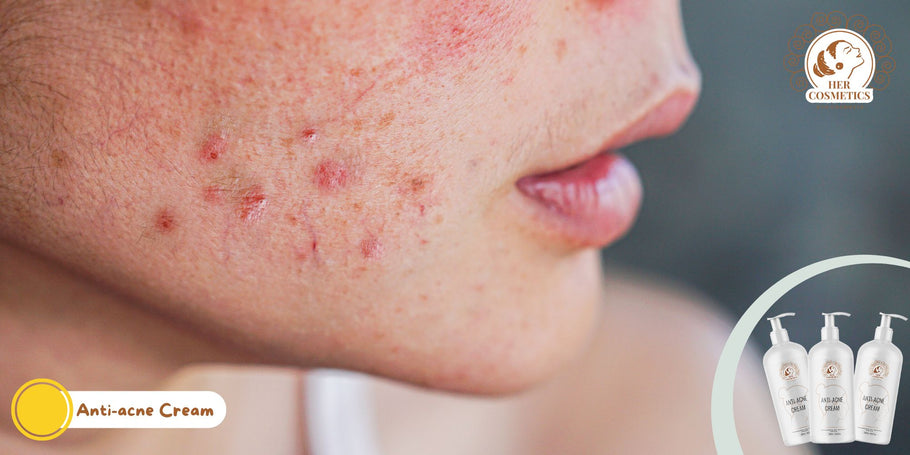 How to get rid of acne on your face?