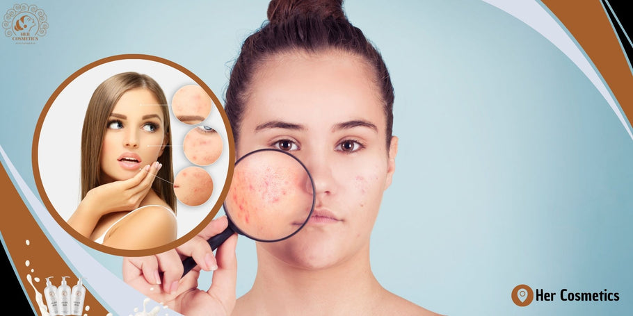 What are the steps to follow to effectively fight acne?